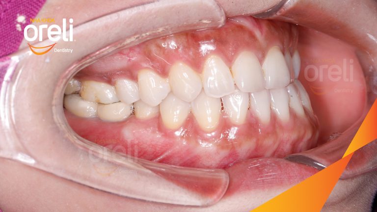 Ca Cấy Ghép Implant Hàm Dưới – Case thực tế tại Oreli