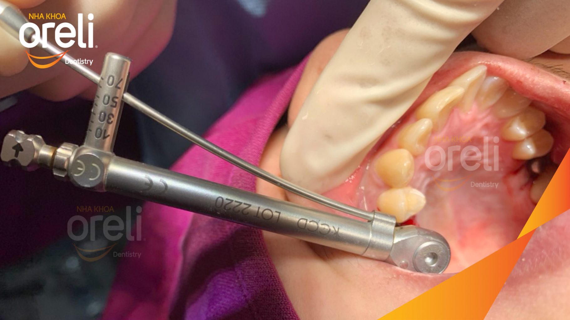 Thực hiện Cấy ghép trụ Implant chính hãng vào vùng mất răng kéo dài 3 tháng tại Oreli
