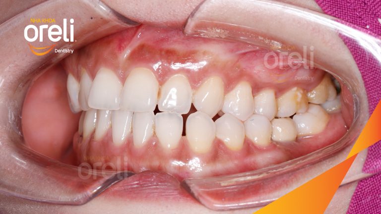 Ca Cấy Ghép Implant Hàm Dưới – Case thực tế tại Oreli