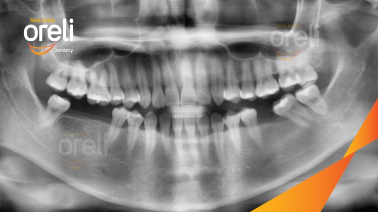 Ca Cấy Ghép Implant Hàm Dưới – Case thực tế tại Oreli