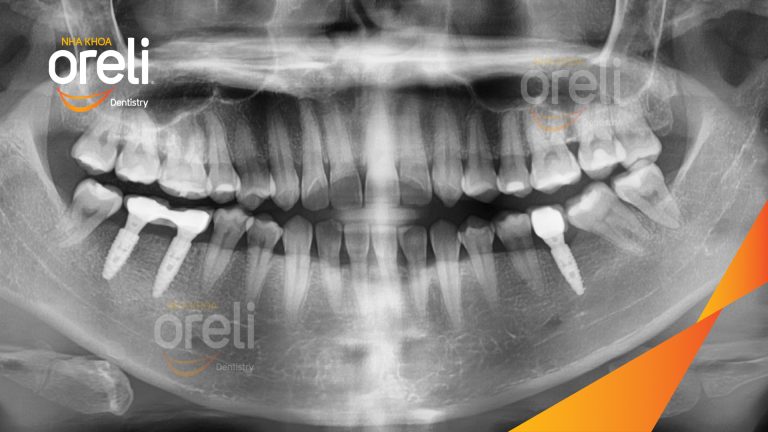 Ca Cấy Ghép Implant Hàm Dưới – Case thực tế tại Oreli