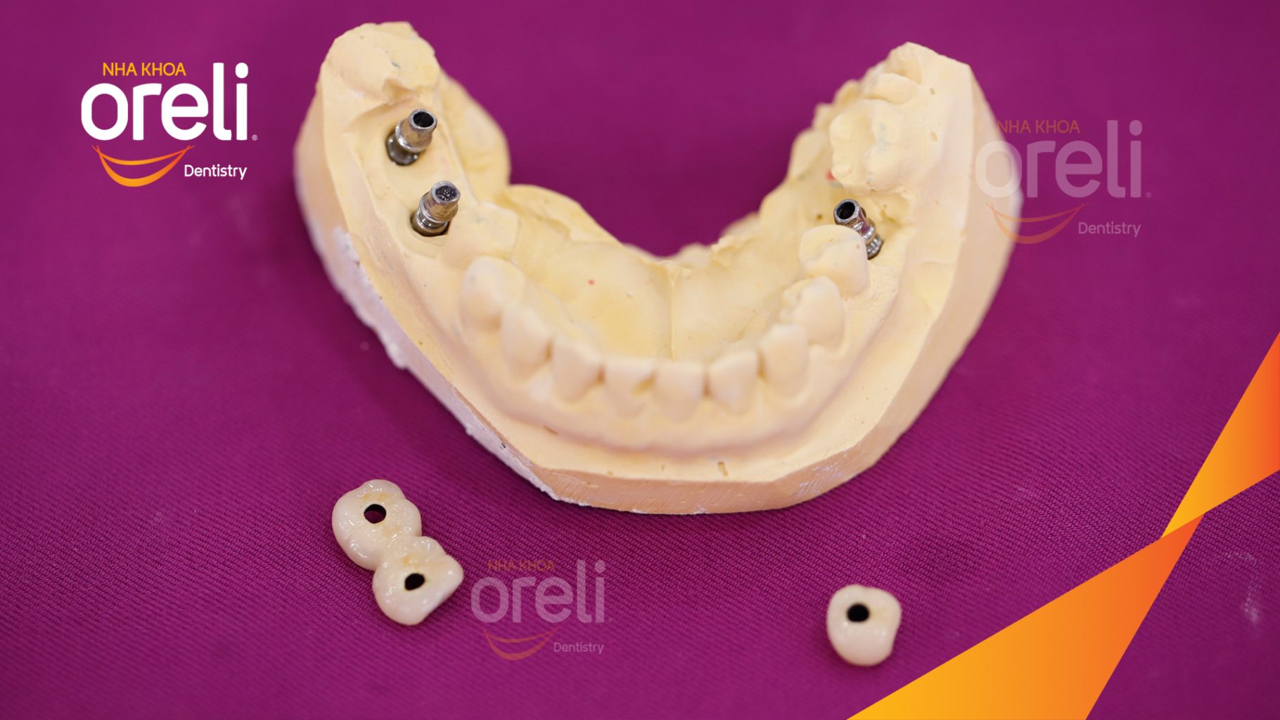 Trước điều trị: Mất răng hàm dưới tại Oreli