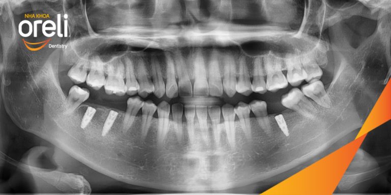 Ca Cấy Ghép Implant Hàm Dưới – Case thực tế tại Oreli