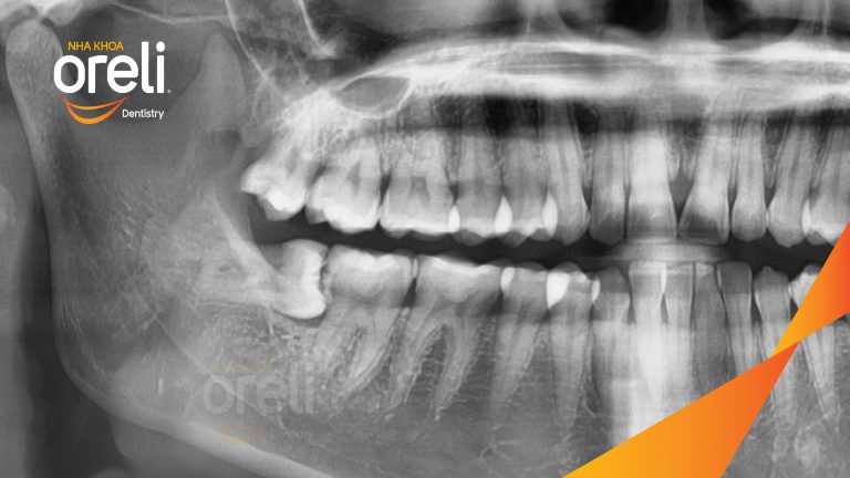 Ca Nhổ Răng Khôn Mọc Lệch Tại Buôn Ma Thuột | Nha khoa Oreli