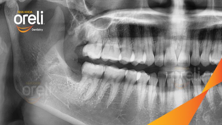 Ca Nhổ Răng Khôn Mọc Lệch Tại Buôn Ma Thuột | Nha khoa Oreli