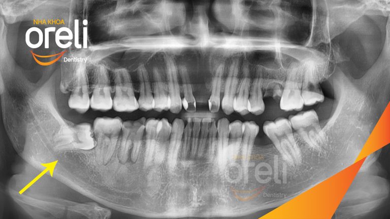 Ca Nhổ Răng Khôn Mọc Lệch Tại Buôn Ma Thuột | Nha khoa Oreli