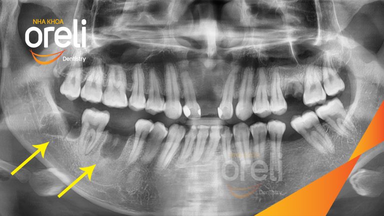 Ca Nhổ Răng Khôn Mọc Lệch Tại Buôn Ma Thuột | Nha khoa Oreli