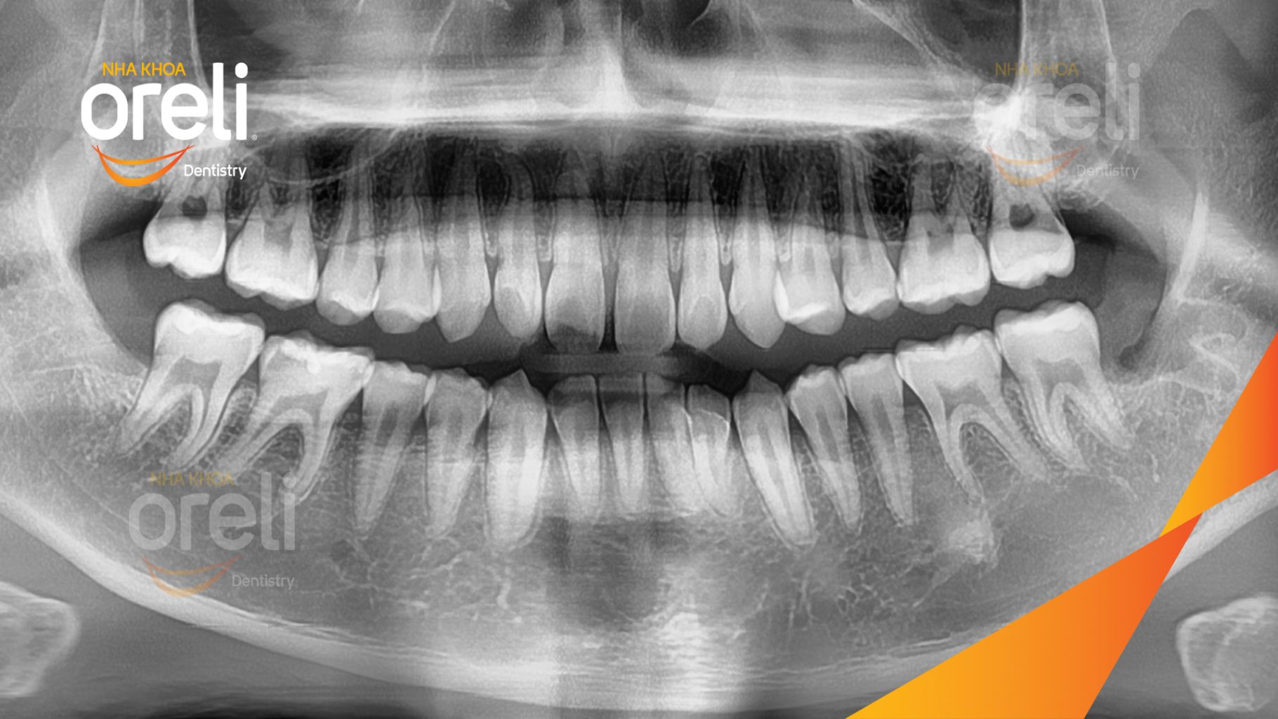 Răng khôn hàm dưới mọc lệch trước khi điều trị tại Oreli