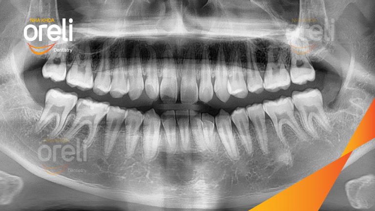 Nhổ răng khôn hàm dưới – Case tại Oreli Buôn Ma Thuột