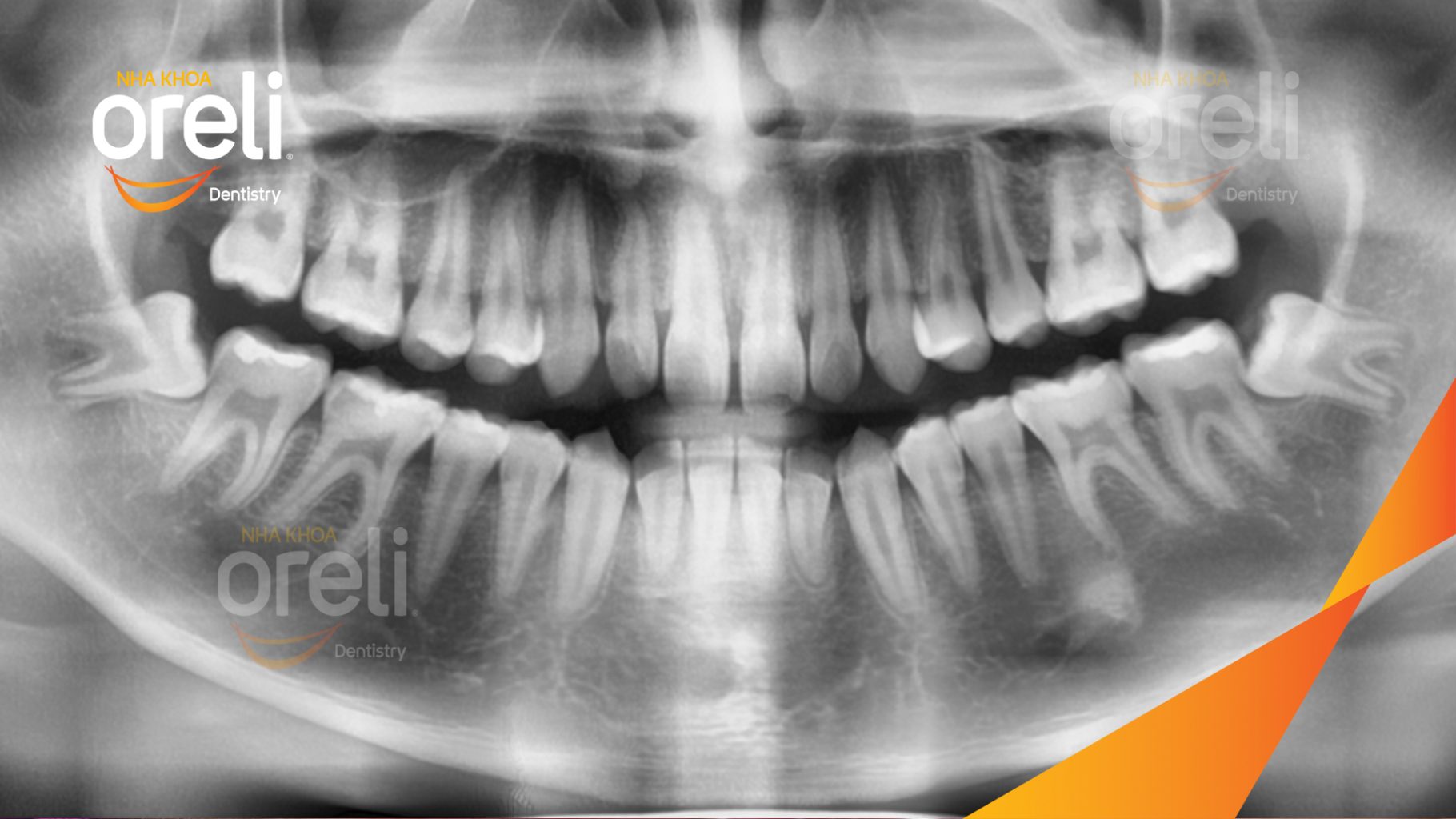 Trước điều trị: Răng khôn hàm dưới mọc lệch tại Oreli