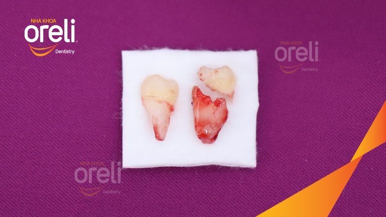 Nhổ răng khôn hàm dưới – Case tại Oreli Buôn Ma Thuột
