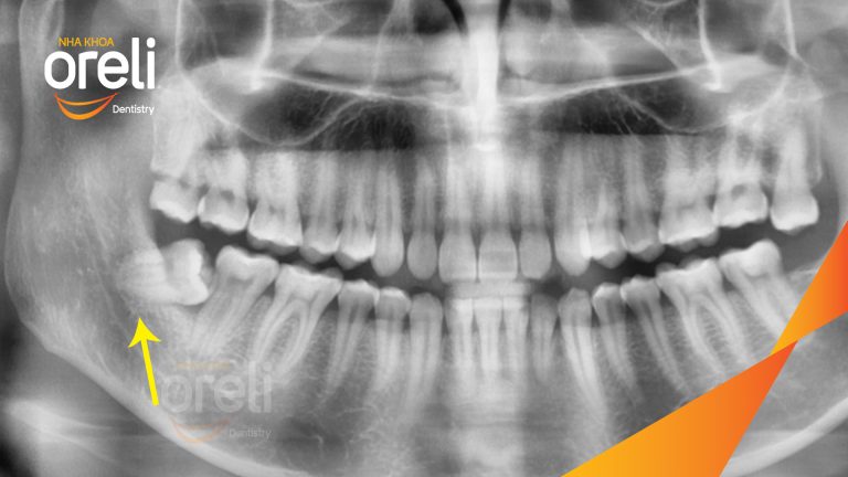Nhổ răng khôn hàm dưới – Case thực tế tại Oreli Buôn Ma Thuột