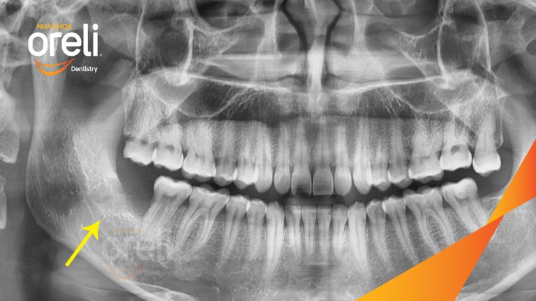 Nhổ răng khôn hàm dưới – Case thực tế tại Oreli Buôn Ma Thuột