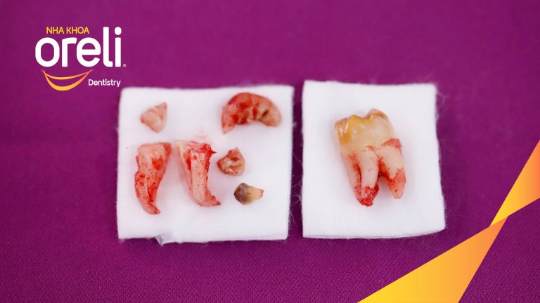 Ca Nhổ Răng Khôn Mọc Lệch Tại Buôn Ma Thuột | Nha khoa Oreli