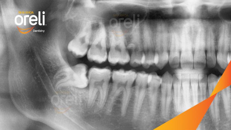 Ca Nhổ Răng Khôn Mọc Lệch Tại Buôn Ma Thuột | Nha khoa Oreli