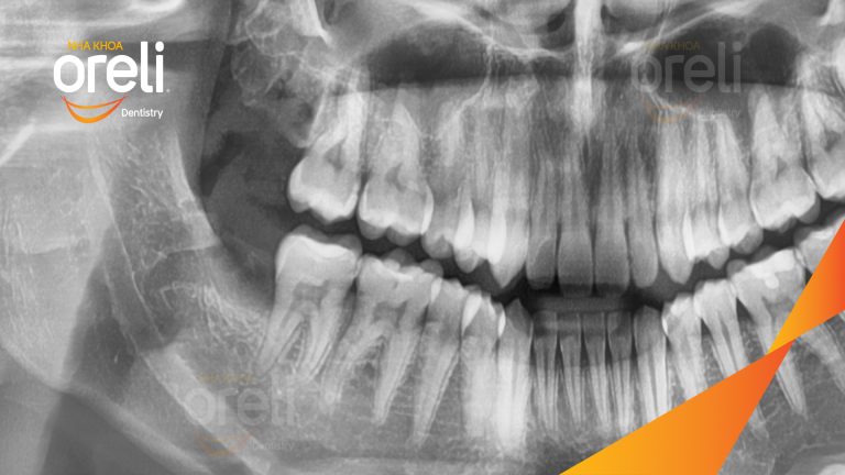 Ca Nhổ Răng Khôn Mọc Lệch Tại Buôn Ma Thuột | Nha khoa Oreli