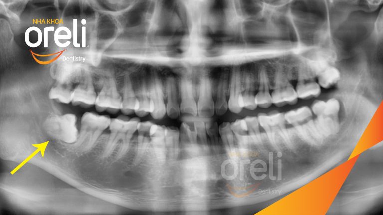 Nhổ răng khôn hàm dưới – Case tại Oreli Buôn Ma Thuột
