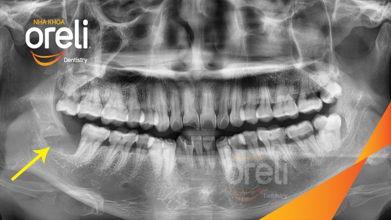 Nhổ răng khôn hàm dưới – Case tại Oreli Buôn Ma Thuột