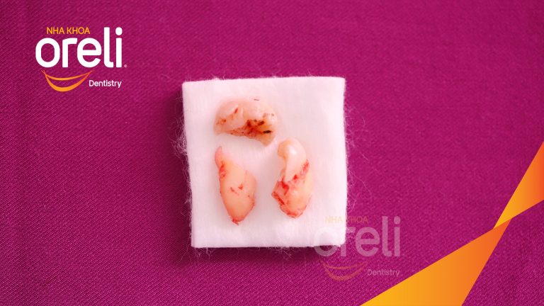Nhổ răng khôn hàm dưới – Case tại Oreli Buôn Ma Thuột