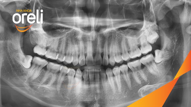 Nhổ răng khôn hàm dưới – Case tại Oreli Buôn Ma Thuột