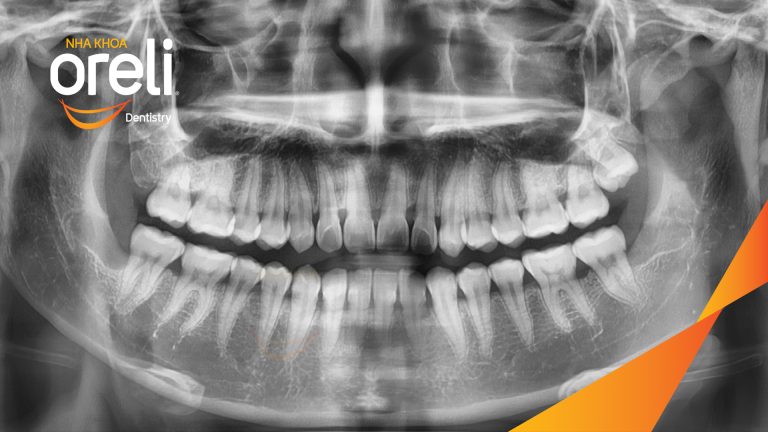 Nhổ răng khôn hàm dưới – Case tại Oreli Buôn Ma Thuột