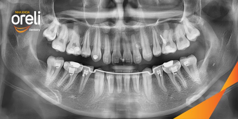 Nhổ răng khôn hàm dưới – Case tại Oreli Buôn Ma Thuột