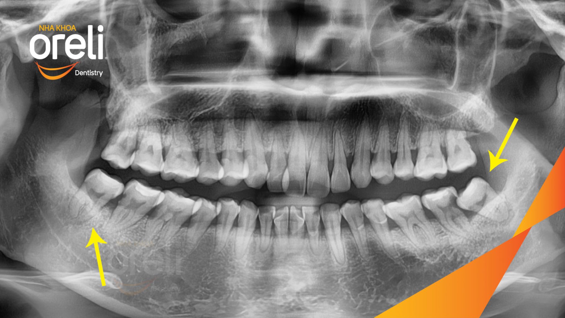 Trước điều trị: Răng khôn hàm dưới mọc lệch tại Oreli