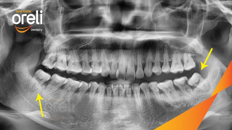 Nhổ răng khôn hàm dưới – Case tại Oreli Buôn Ma Thuột