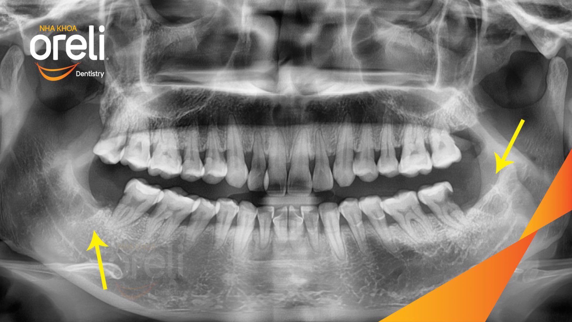 Răng khôn hàm dưới mọc lệch trước khi điều trị tại Oreli