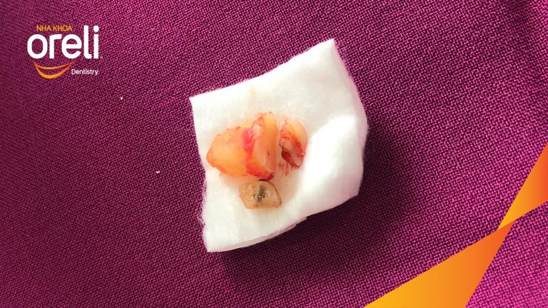 Nhổ răng khôn hàm dưới – Case thực tế tại Oreli Buôn Ma Thuột