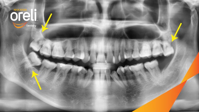 Ca Nhổ Răng Khôn Mọc Lệch Tại Buôn Ma Thuột | Nha khoa Oreli