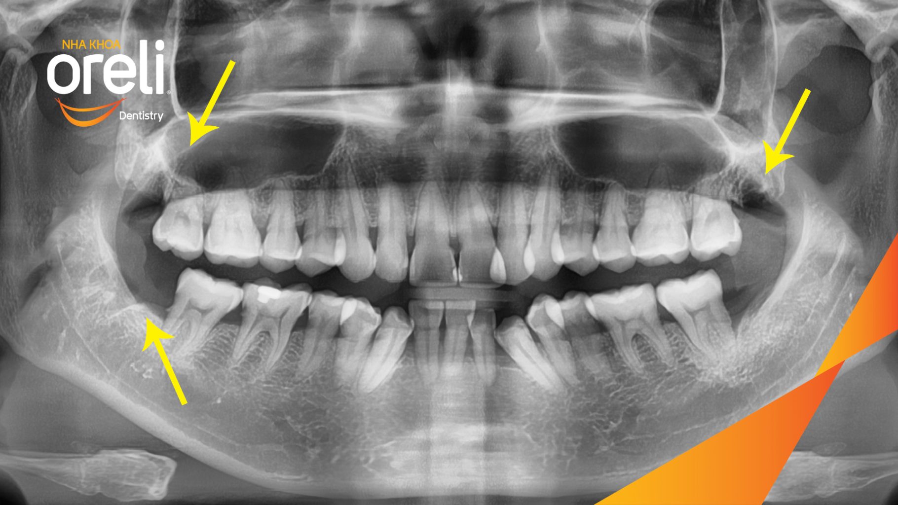 Răng khôn hàm trên và dưới mọc lệch trước khi điều trị tại Oreli