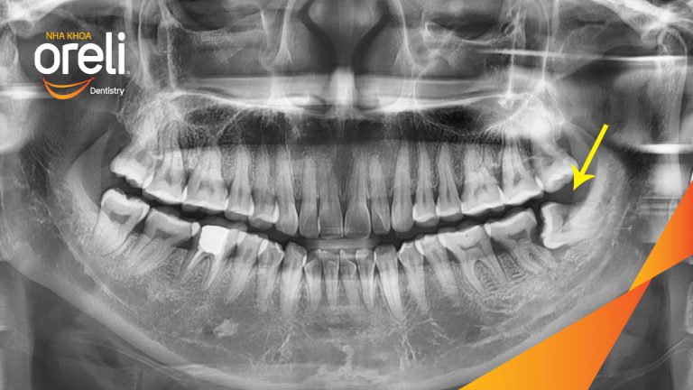 Nhổ răng khôn hàm dưới – Case thực tế tại Oreli Buôn Ma Thuột