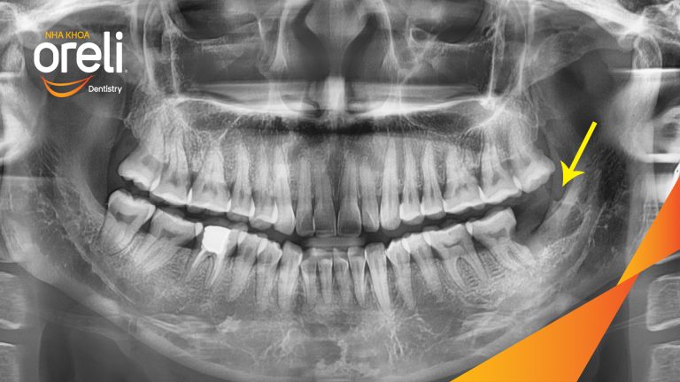 Nhổ răng khôn hàm dưới – Case thực tế tại Oreli Buôn Ma Thuột