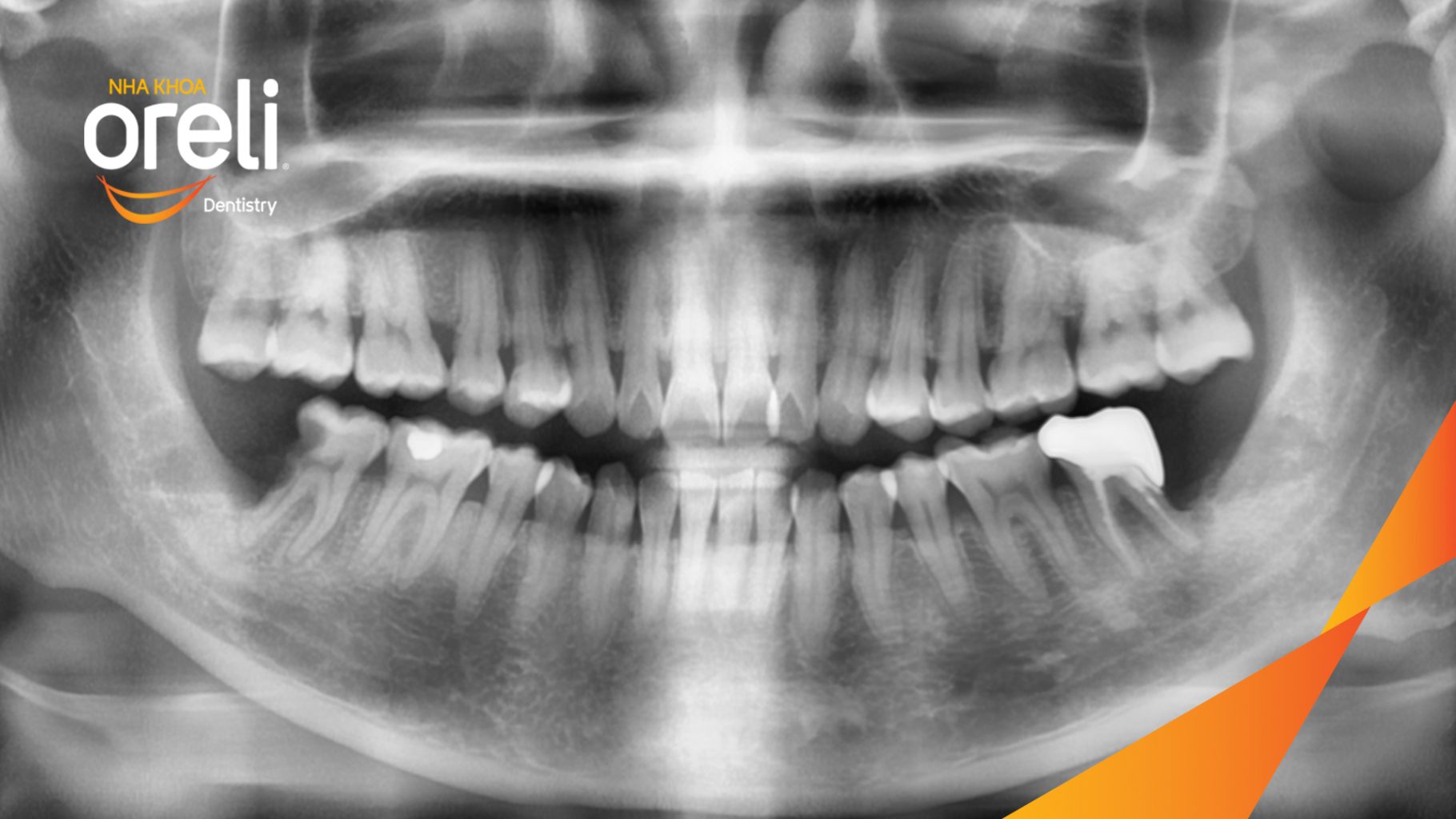 Răng khôn hàm dưới mọc lệch trước khi điều trị tại Oreli