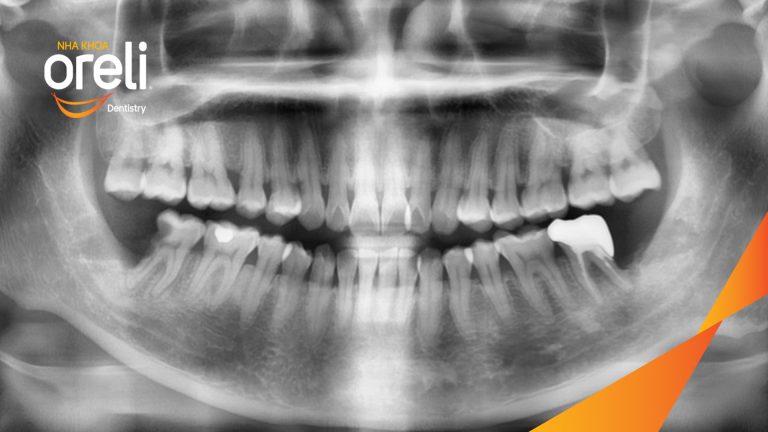 Ca Nhổ Răng Khôn Mọc Lệch Tại Buôn Ma Thuột | Nha khoa Oreli