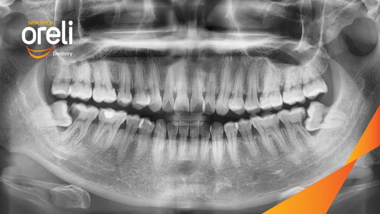 Ca Nhổ Răng Khôn Mọc Lệch Tại Buôn Ma Thuột | Nha khoa Oreli
