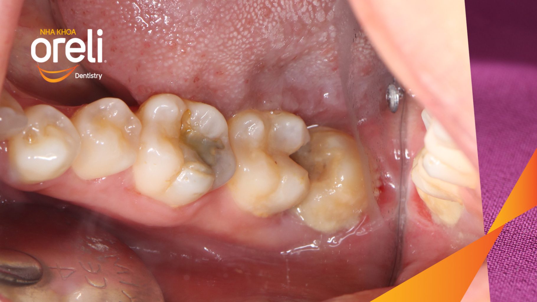 Kết quả sau 1 tiếng: Toàn bộ thân răng và chân răng được lấy bỏ tại Oreli