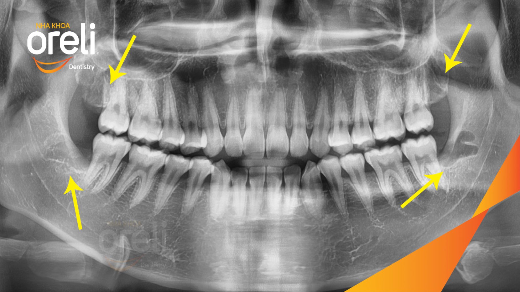 Răng khôn mọc lệch trước khi điều trị tại Oreli
