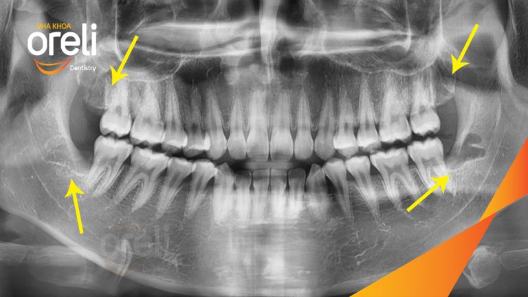 Ca Nhổ Răng Khôn Mọc Lệch Tại Buôn Ma Thuột | Nha khoa Oreli