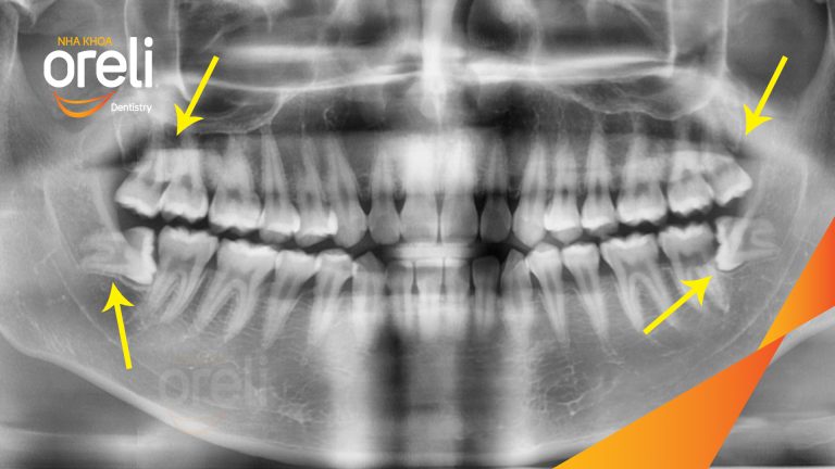 Ca Nhổ Răng Khôn Mọc Lệch Tại Buôn Ma Thuột | Nha khoa Oreli