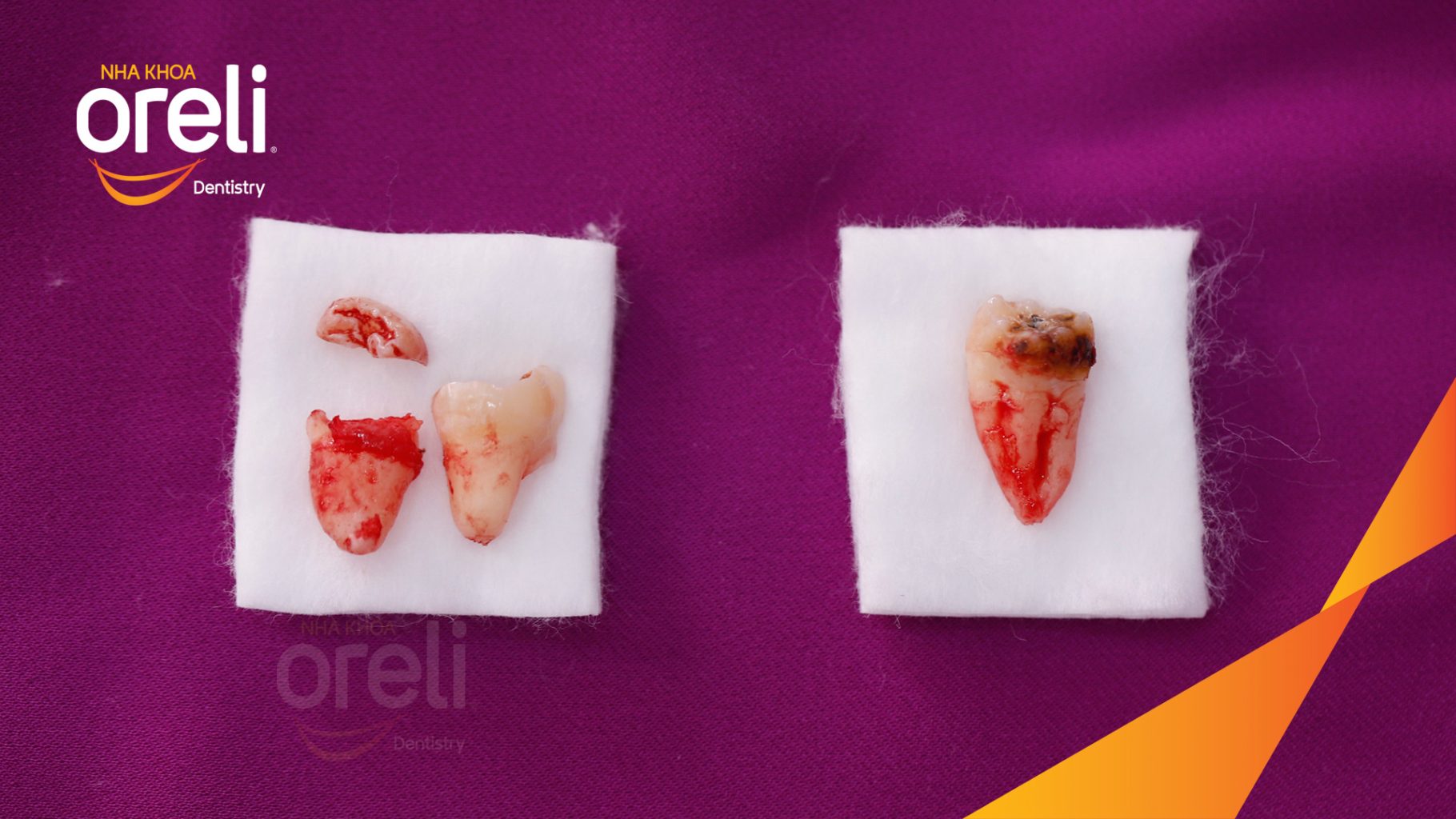 Quá trình Nhổ răng khôn trong 1 tiếng tại Oreli