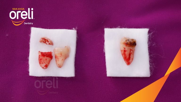 Ca Nhổ Răng Khôn Mọc Lệch Tại Buôn Ma Thuột | Nha khoa Oreli
