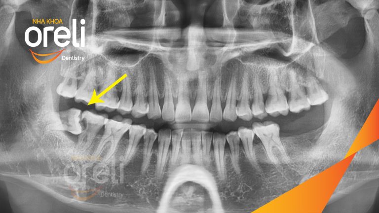 Nhổ răng khôn hàm dưới – Case tại Oreli Buôn Ma Thuột