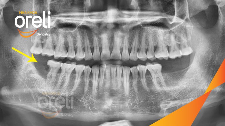 Nhổ răng khôn hàm dưới – Case tại Oreli Buôn Ma Thuột
