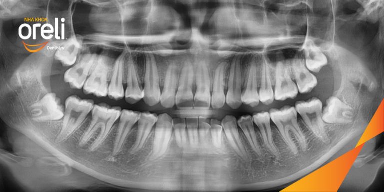Nhổ răng khôn hàm dưới – Case tại Oreli Buôn Ma Thuột