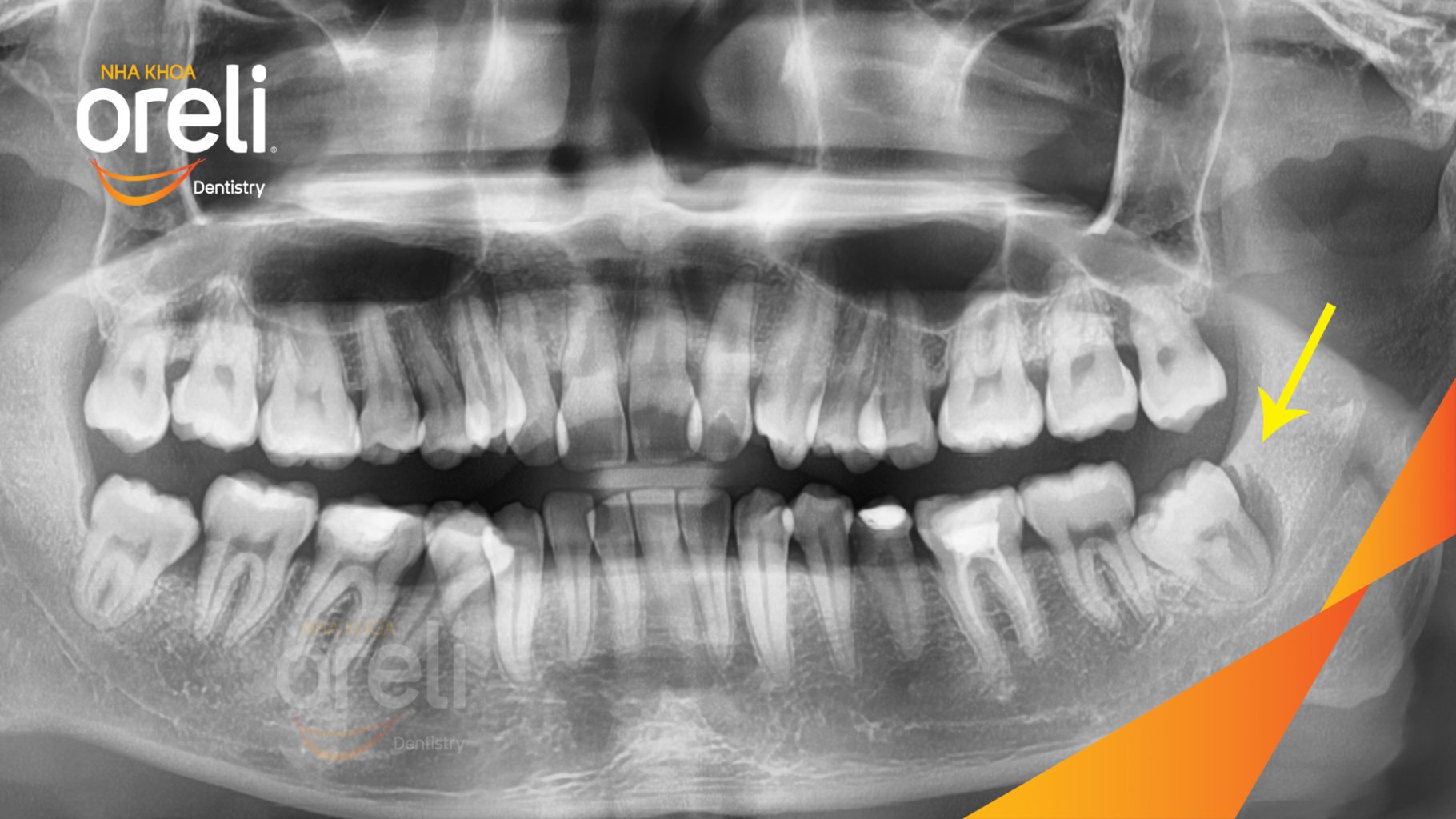 Trước điều trị: Răng khôn hàm dưới mọc lệch tại Oreli