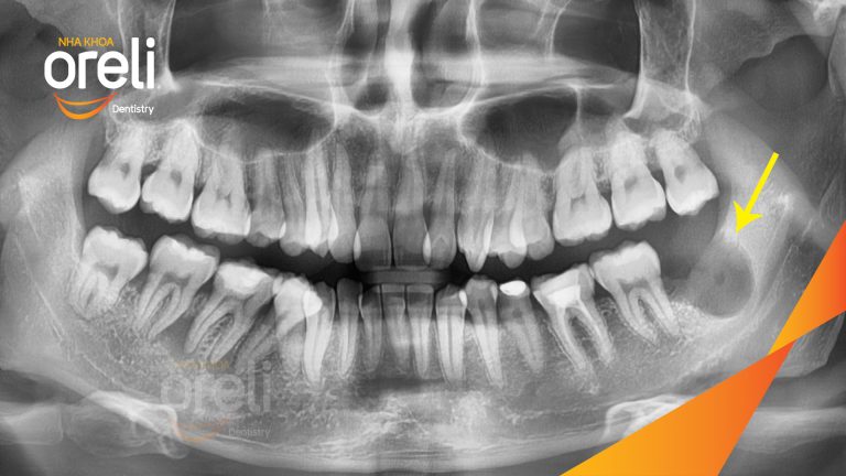 Ca Nhổ Răng Khôn Mọc Lệch Tại Buôn Ma Thuột | Nha khoa Oreli