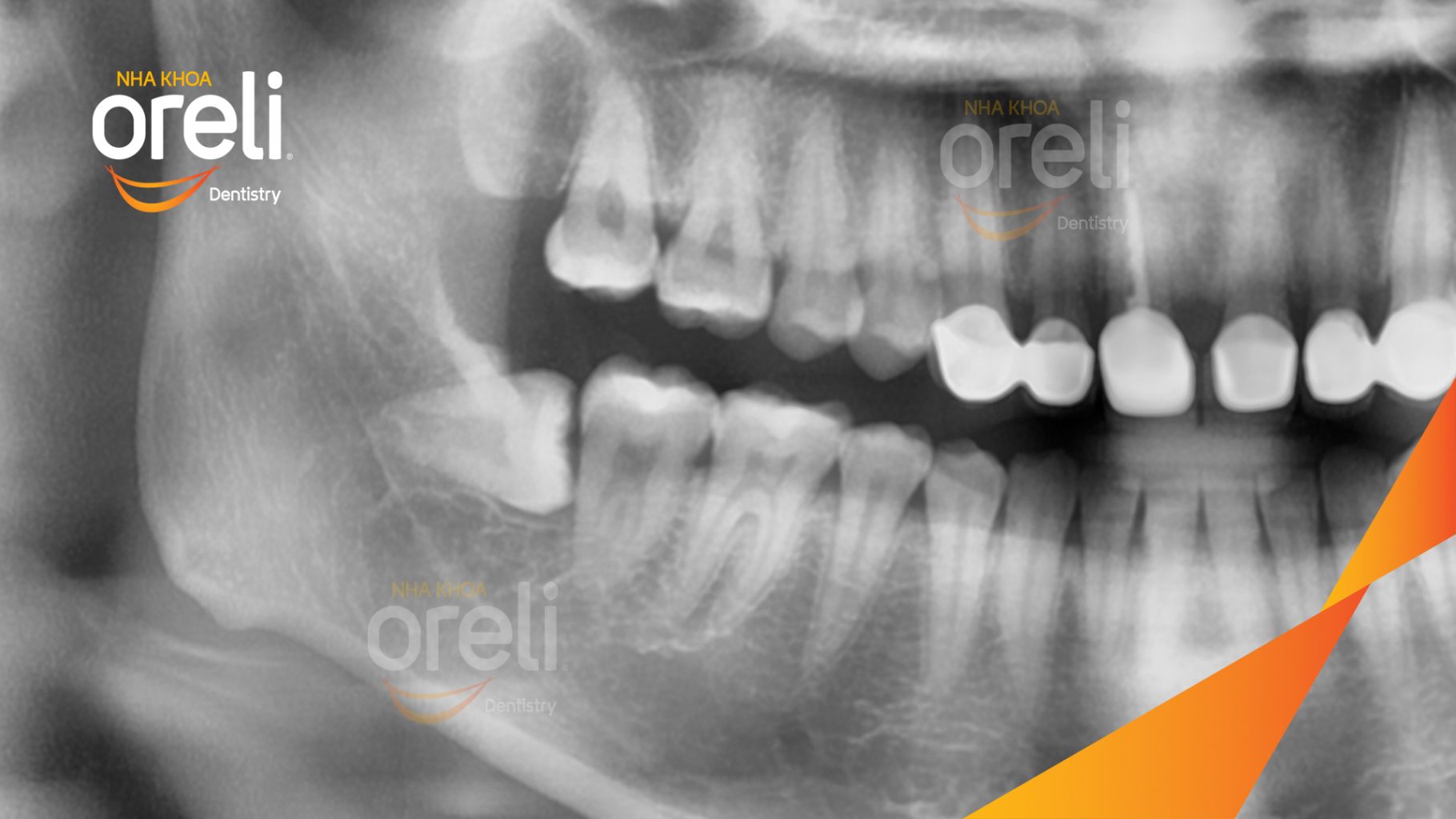 Trước điều trị: Răng khôn hàm dưới mọc lệch tại Oreli