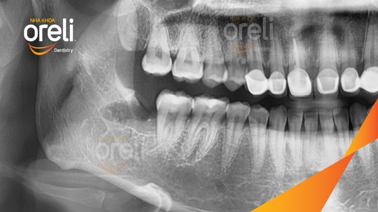 Ca Nhổ Răng Khôn Mọc Lệch Tại Buôn Ma Thuột | Nha khoa Oreli